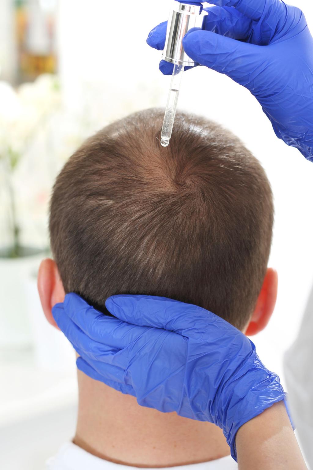 Estimulación Capilar Profesional – Activación del Folículo y Crecimiento del Cabello