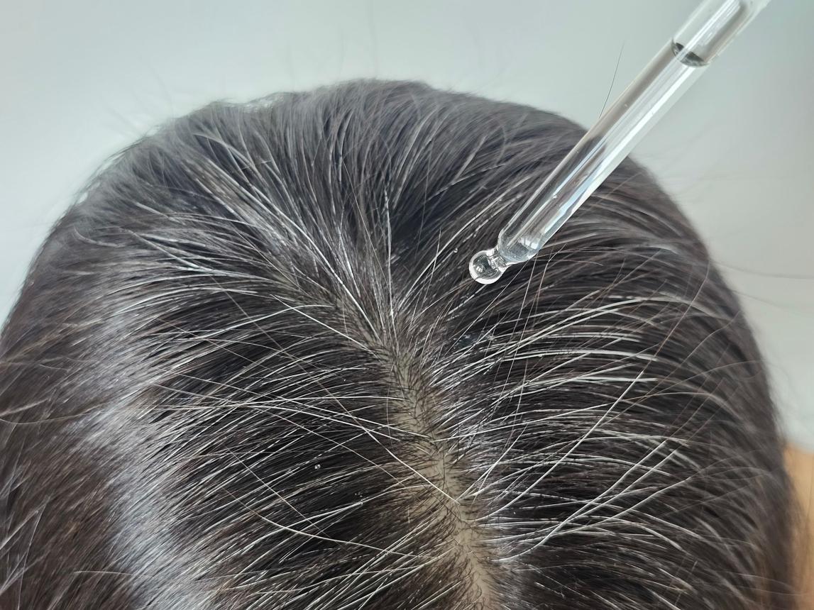TRATAMIENTOS CON MINOXIDIL