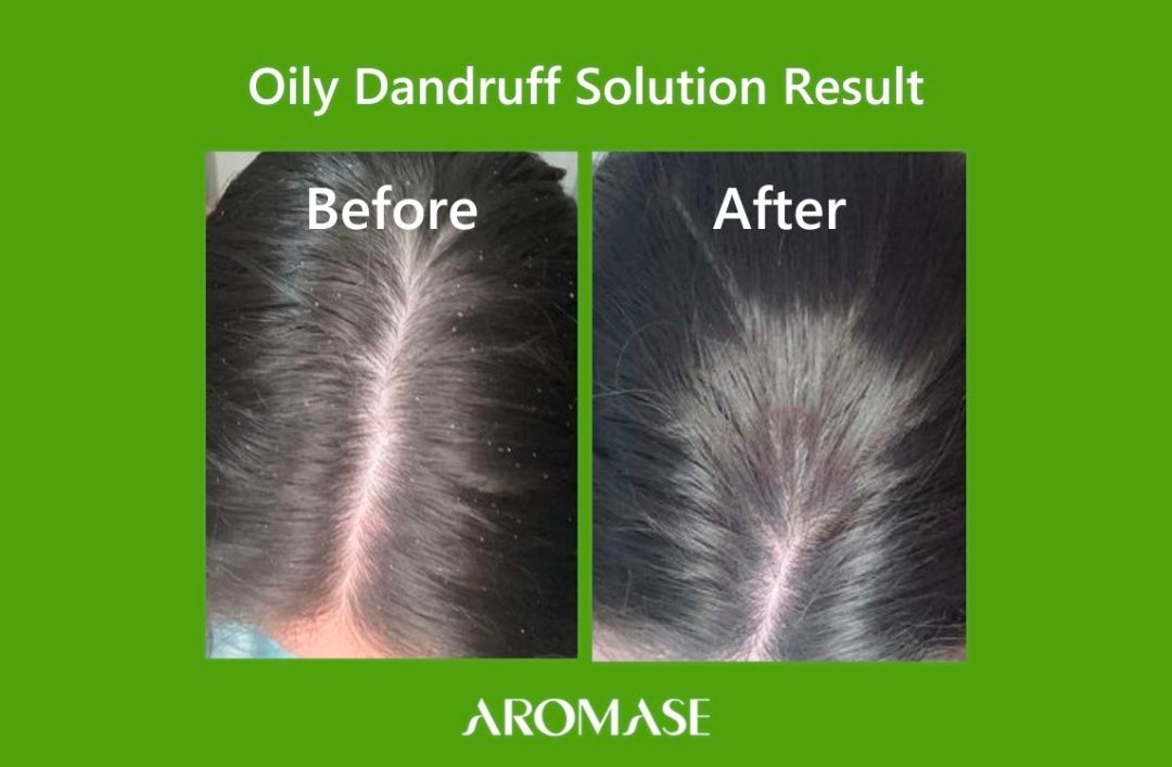 Control de Grasa Capilar