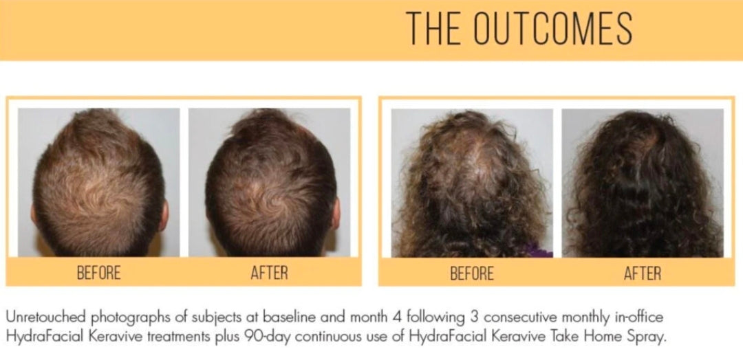 Estimulación del Crecimiento Capilar